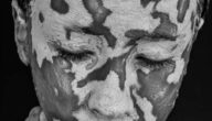 Was ist Vitiligo Arten von Vitiligo