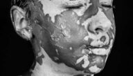 Wie Vitiligo beginnt Wie Vitiligo beginnt
