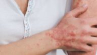 Der Unterschied zwischen Psoriasis und Ekzemen Der Unterschied zwischen Psoriasis und Ekzemen