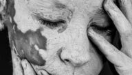 Ursachen der Vitiligo-Krankheit Was ist Vitiligo