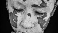 Wie Vitiligo beginnt Wie Vitiligo beginnt