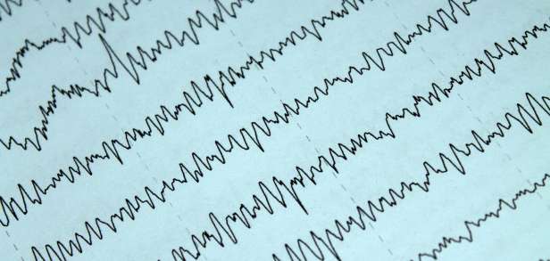 Was Könnte Es Sein Wenn Ein Eeg Auffällig Ist